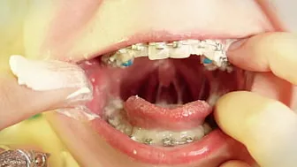 Eating In Braces - Close Up Video - Food Fetish - Mouth Tour