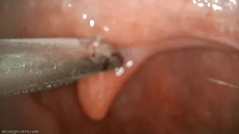 Uvula Manipulation With Swab And Forceps (1080 Wmv)